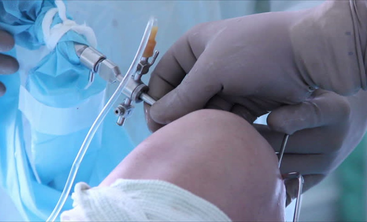 Leading Orthopedic Trauma Surgeon Hyderabad | Dr Aravind Gourishetty